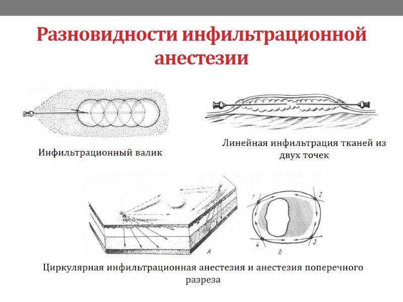 Разновидности инфильтрационной анестезии Инфильтрационный валик Линейная инфильтрация тканей из двух точек Циркулярная инфильтрационная анестезия